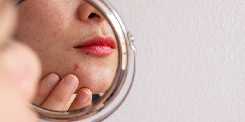How To Help Hormonal Skin?