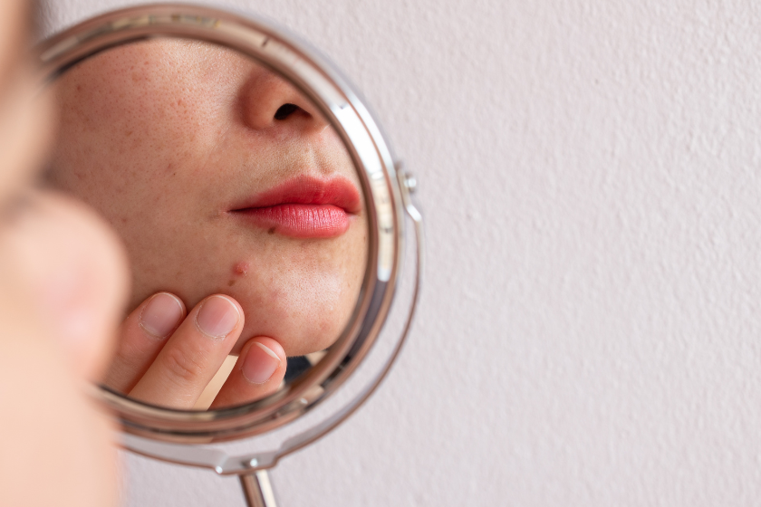 How To Help Hormonal Skin?